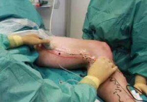 Stripping Laser Versailles epilation